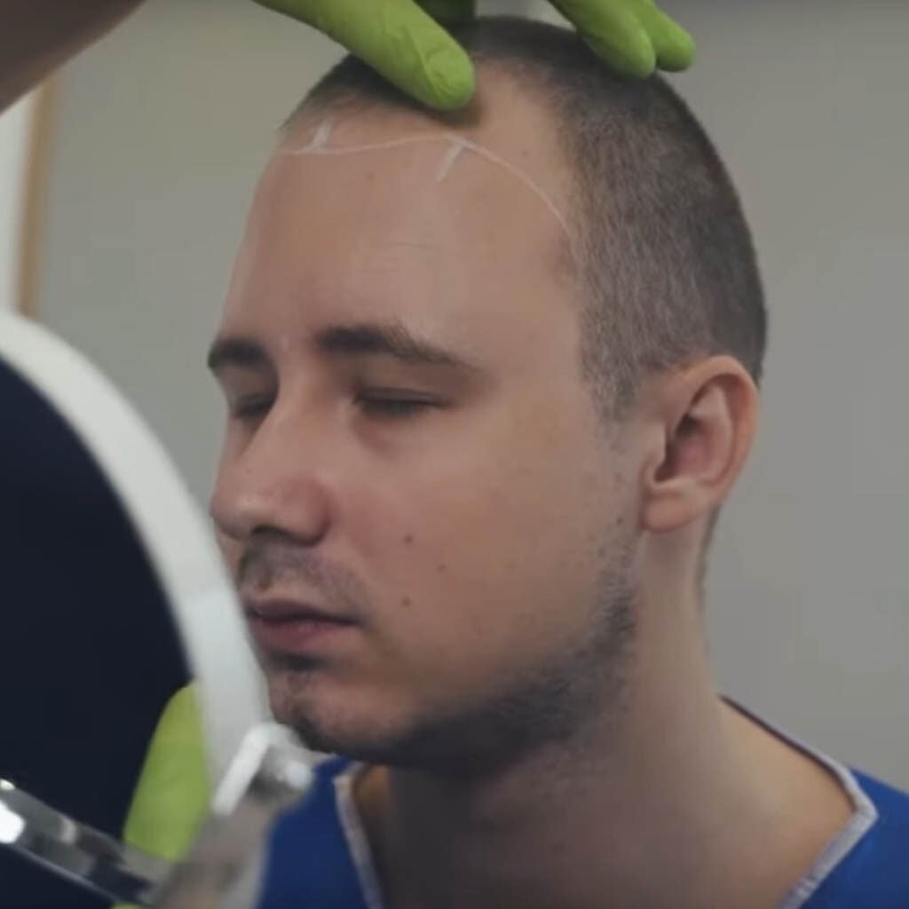 Dawid Blachura yachuprodukcja przeszczep włosów