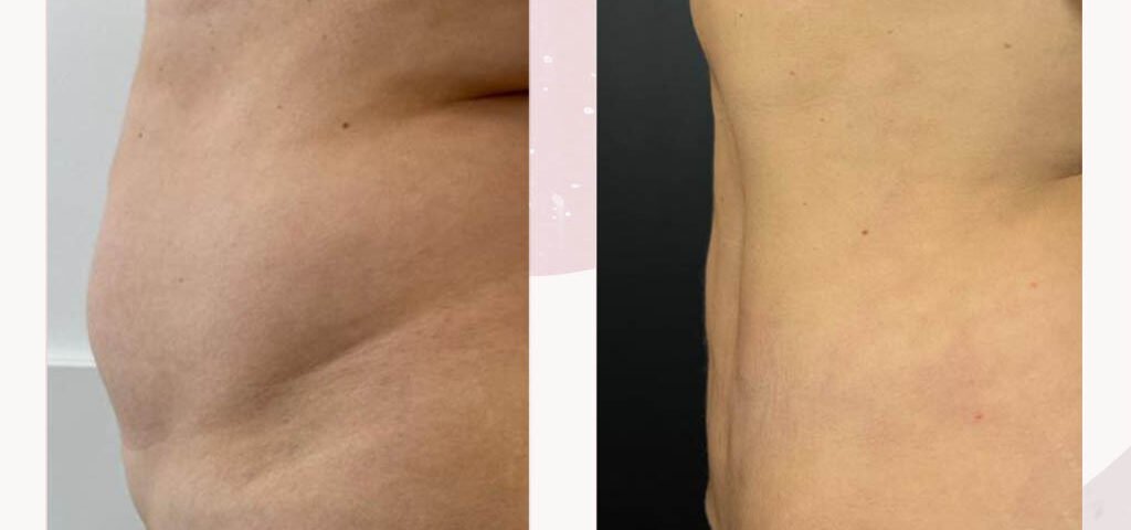 liposukcja efekt plaski brzuch liposukcja efekt plaski brzuch