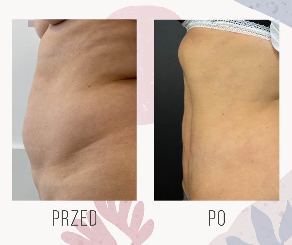 liposukcja efekt plaski brzuch
