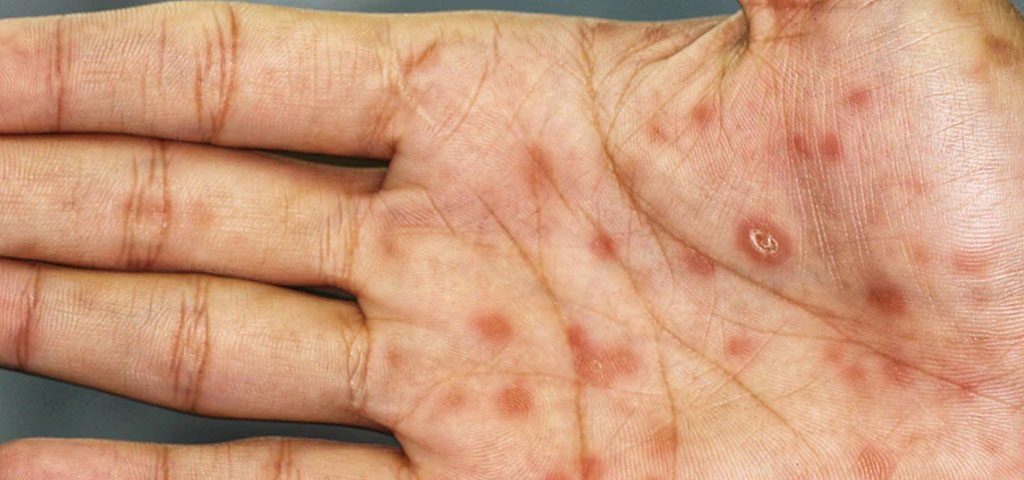 kila syfilis diagnostyka i leczenie kila syfilis diagnostyka i leczenie