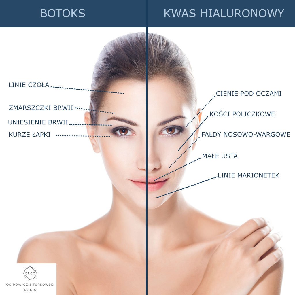 toksyna botulinowa kwas hialuronowy roznice