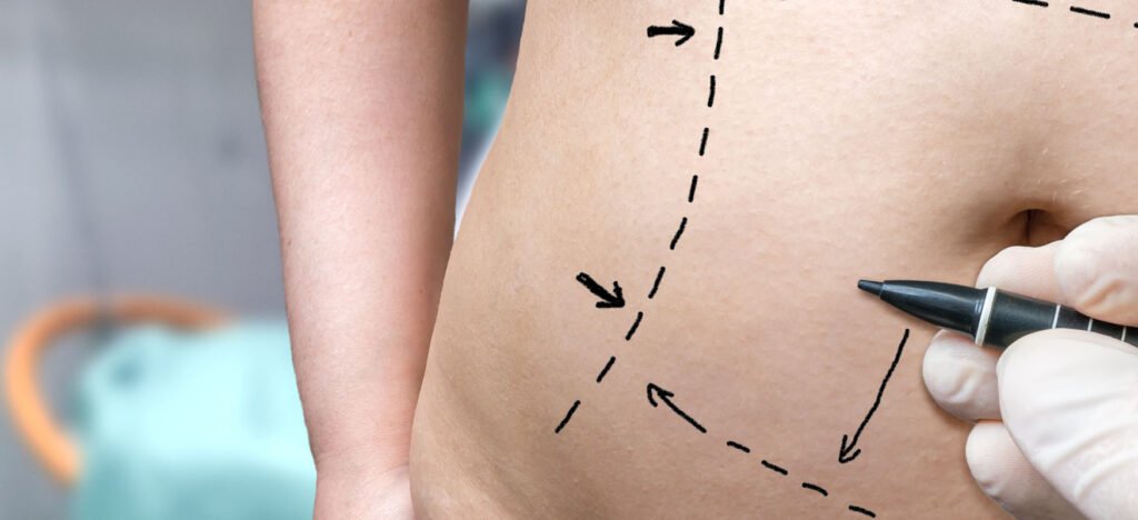 abdominoplastyka