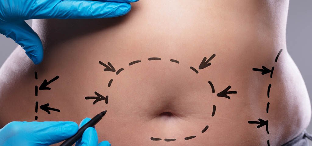 operacja plastyczna brzucha - abdominoplastyka operacja plastyczna brzucha - abdominoplastyka