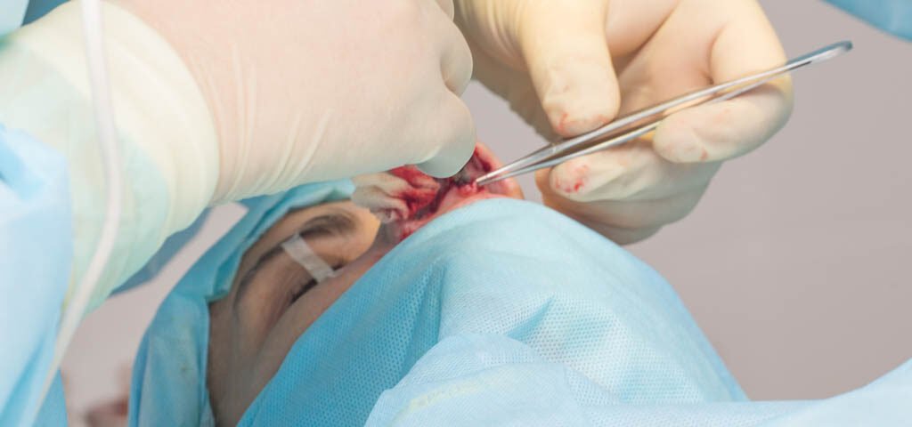 operacja nosa PIEZO operacja nosa PIEZO