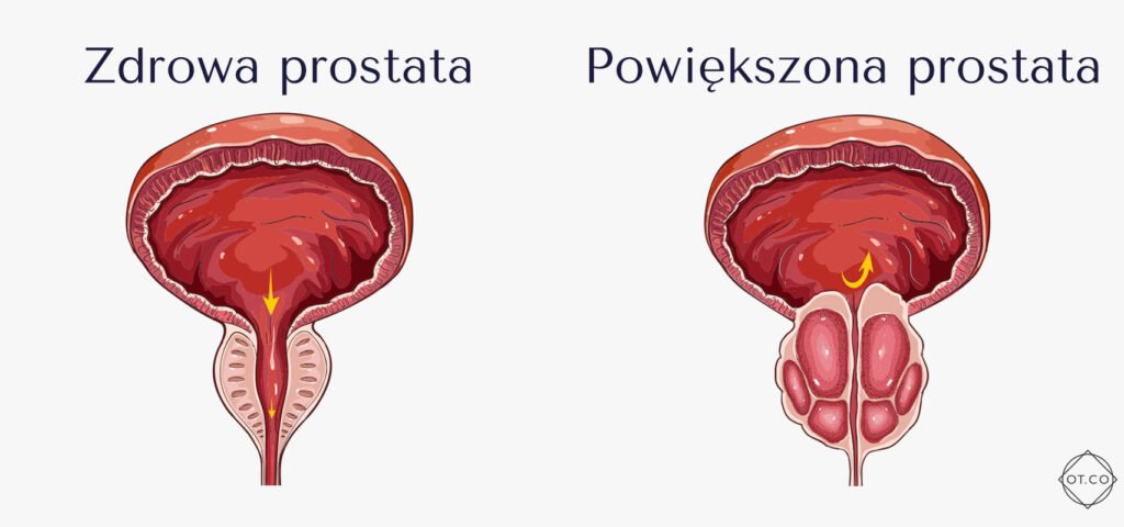 zdrowa prostata, powiększona prostata zdrowa prostata, powiększona prostata