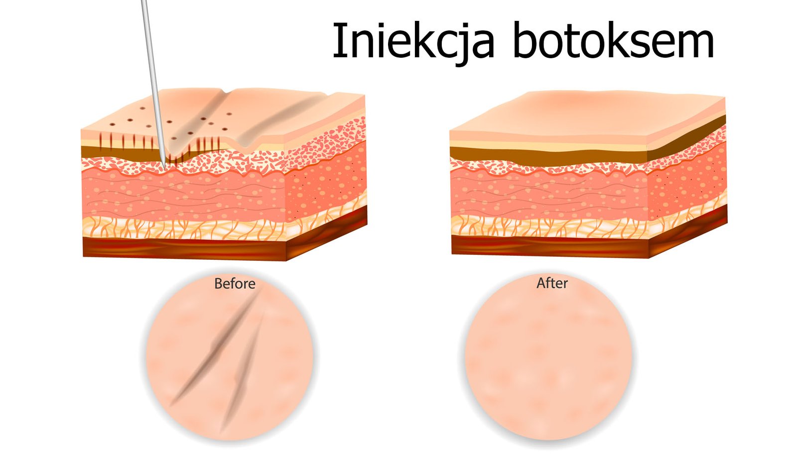iniekcja botoksem iniekcja botoksem